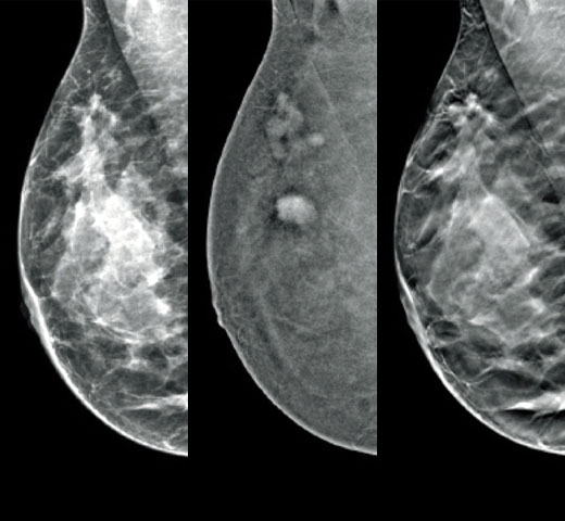 Técnica de imagem com contraste I-View™ da Hologic