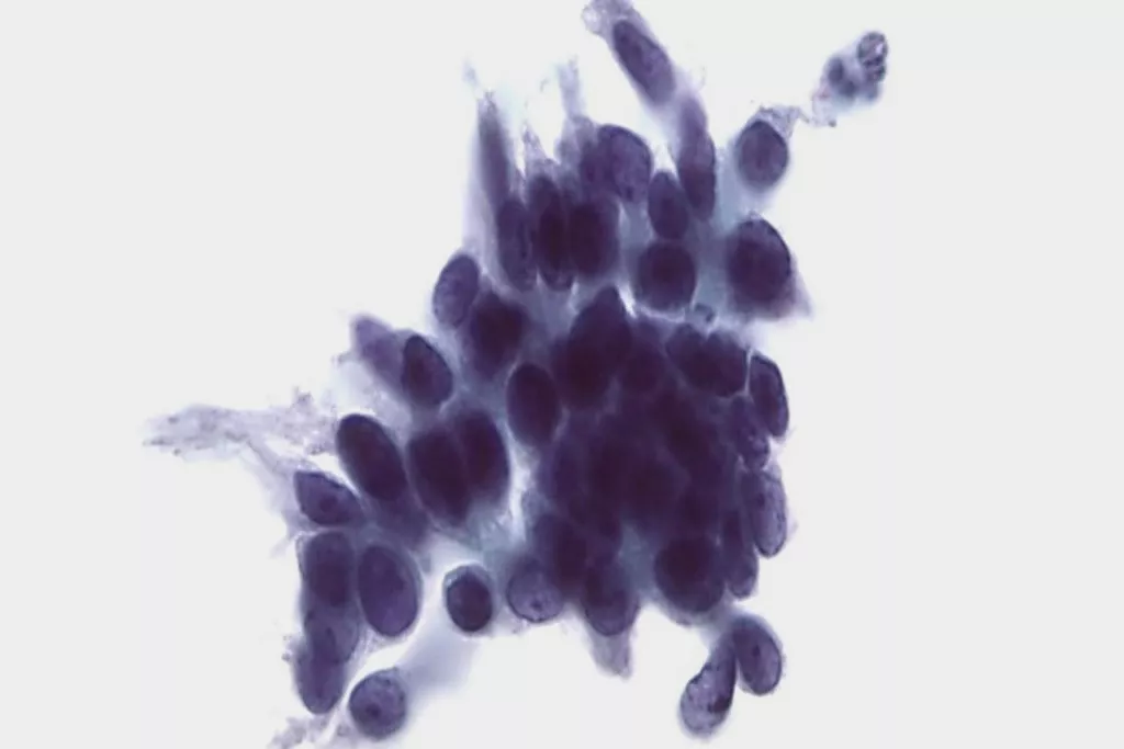 Teste de Papanicolau com neoplasia intraepitelial cervical glandular
