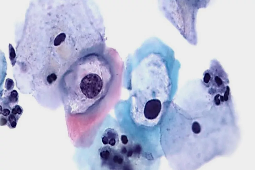 Teste de Papanicolau com discariose de baixo grau com HPV