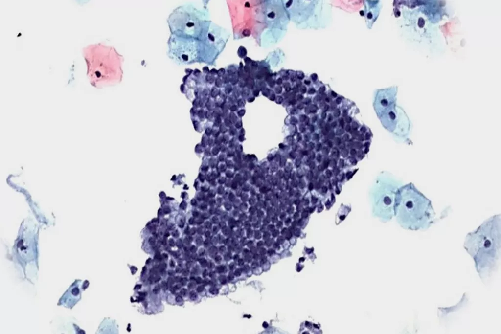 Teste de Papanicolau negativo com células endocervicais