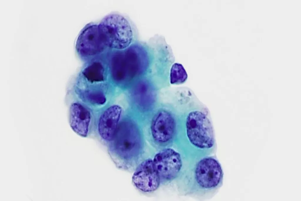 Adenocarcinoma, lavado brônquico, coloração de Papanicolau