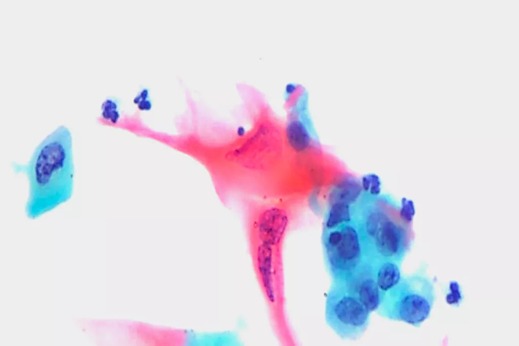 Carcinoma espinocelular, urina, coloração de Papanicolau