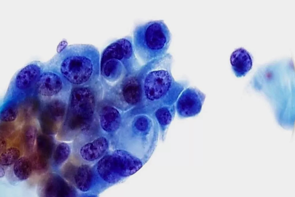 Carcinoma de células transitórias, grau 3, urina, coloração de Papanicolau