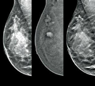 Técnica de imagem com contraste I-View™ da Hologic