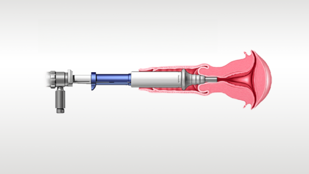 Ilustração do dispositivo médico em utilização.